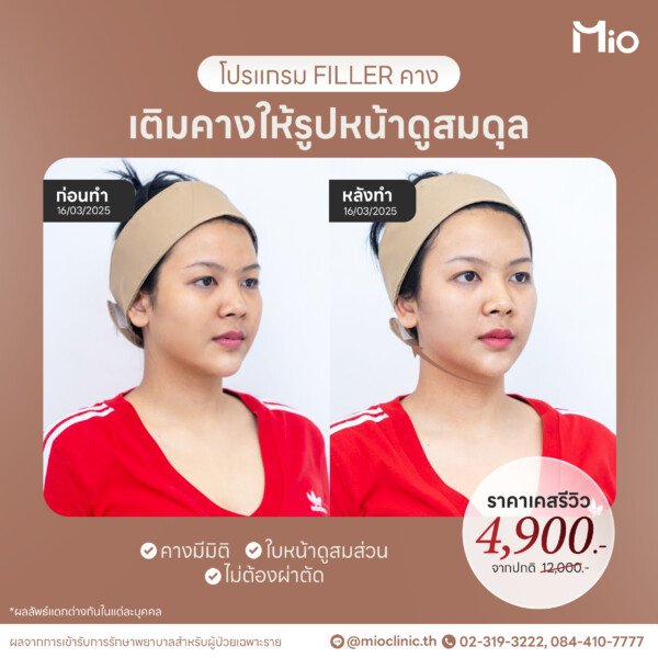 u3 filler คาง ปรับรูปหน้า เสริมมิติ รีวิวจริง mio clinic พระราม9