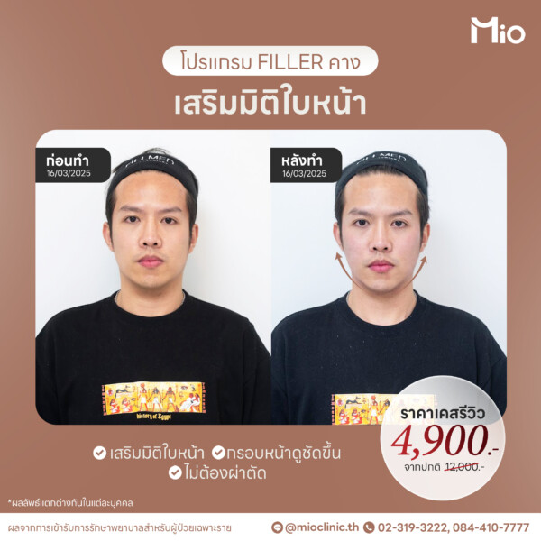 u3 filler คาง ผู้ชาย กรอบหน้าชัด รีวิวจริง mio clinic พระราม9