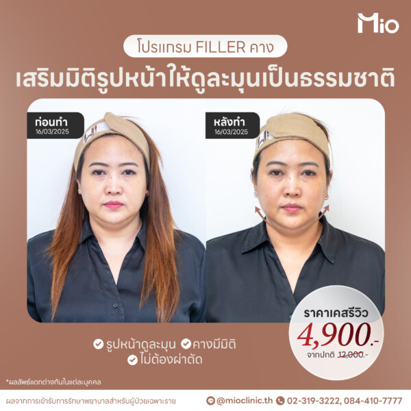 u3 filler คาง เสริมมิติรูปหน้า รีวิวจริง mio clinic พระราม9