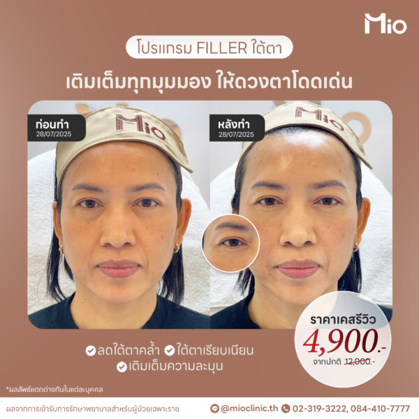 u3 filler ใต้ตา ลดคล้ำ เติมความละมุน รีวิวจริง mio clinic พระราม9