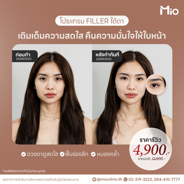 u3 filler ใต้ตา เติมร่องลึก รีวิวจริง mio clinic พระราม9