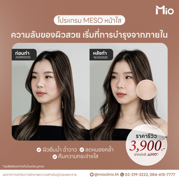 u3 meso หน้าใส ผิวอิ่มน้ำ ลดหมองคล้ำ mio clinic 1