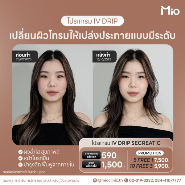 u3 mio iv drip secreat c promotion