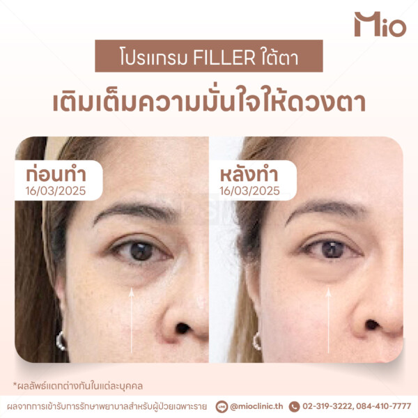 filler under eye dark circle mio clinic.jpg