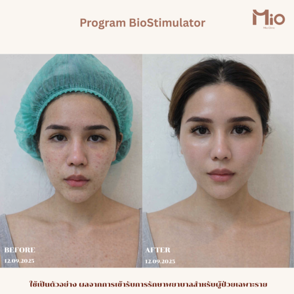 biostimulator-review-before-after-front-mio-clinic.jpg-2