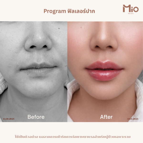 lip filler mio clinic before after 01.jpg