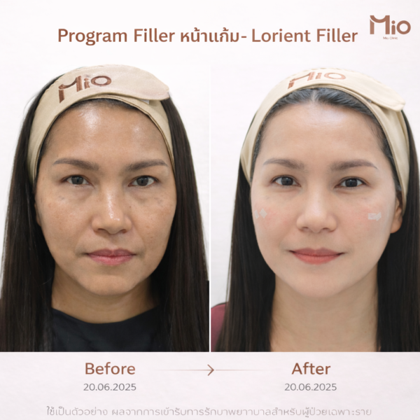lorient filler cheek before after mio clinic 01.jpg
