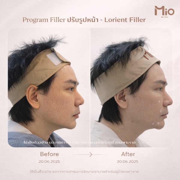 lorient filler face contouring before after mio clinic 01.jpg 1