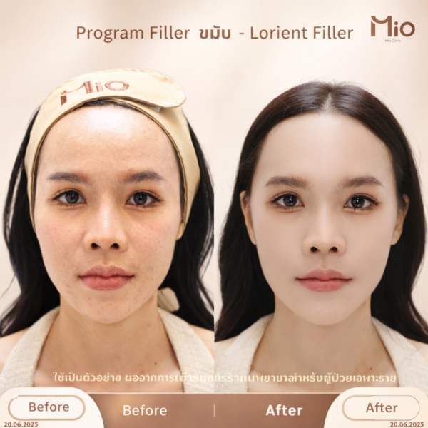 lorient filler temple before after mio clinic 01.jpg