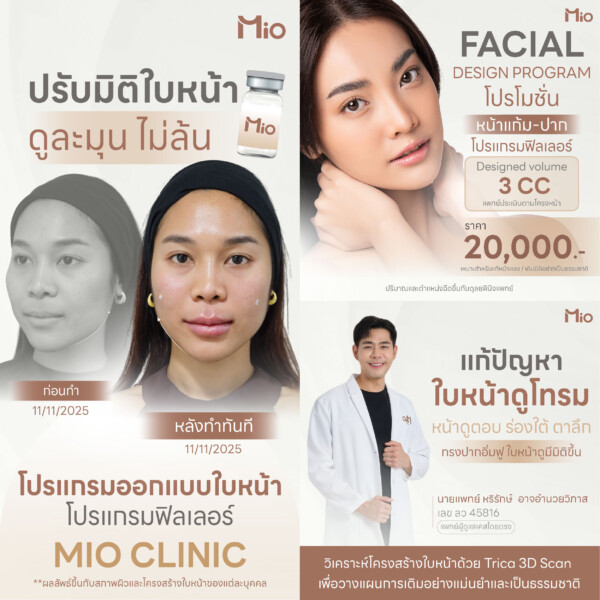 mio-clinic-natural-look-filler-midcheek-lips.jpg
