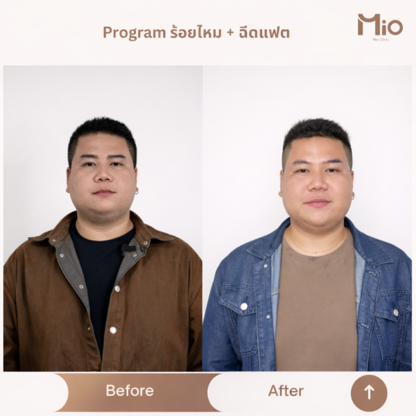 thread lift fat dissolving face contour before after mio clinic.jpg