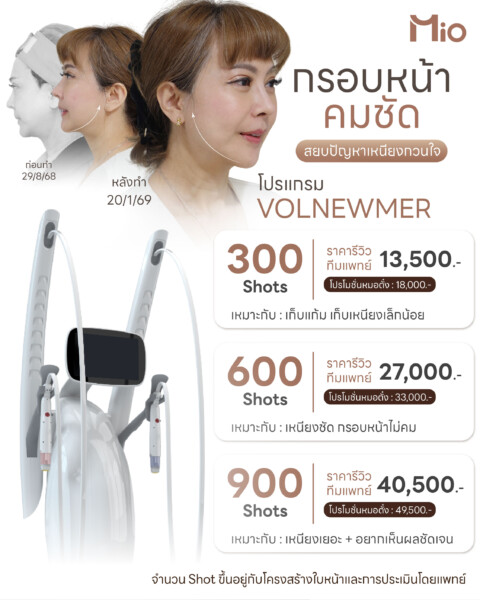 volnewmer ยกกระชับ แก้มเหนียง กรอบหน้า mio clinic.jpg