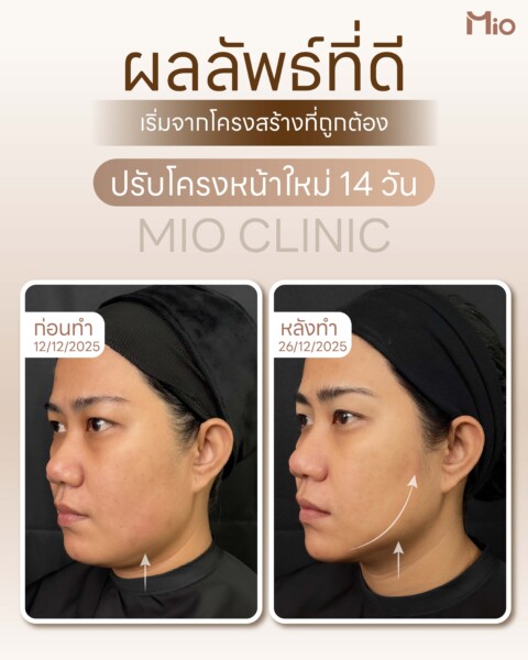 doublo 2 review 14 days mio clinic