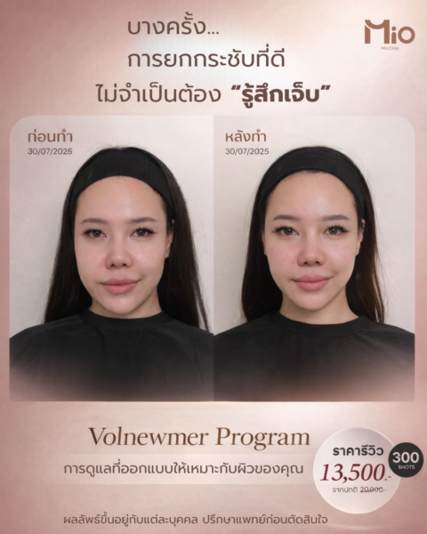 volnewmer review before after 300shots mio clinic