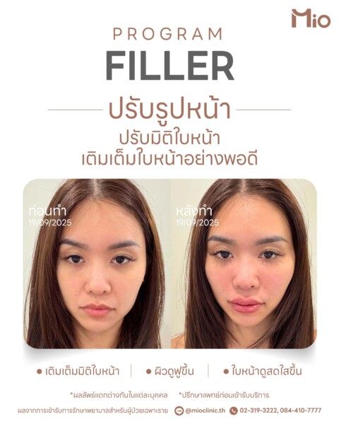 filler face shaping review mio clinic 07
