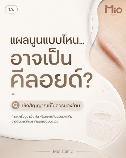 keloid raised scar mio clinic.webp 1