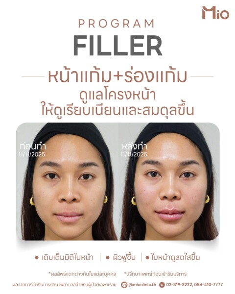 program filler midface volume review 02