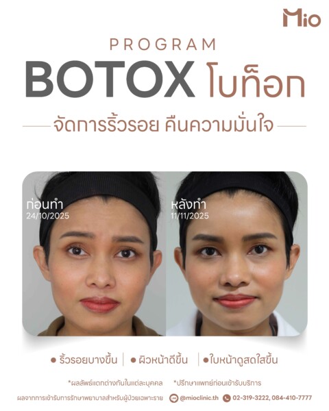 review program botox mio clinic before after