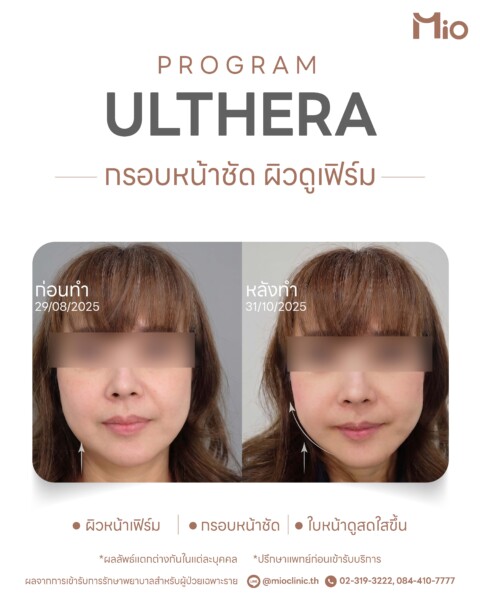 review program ulthera mio clinic before after