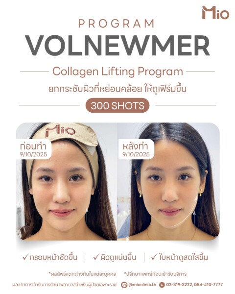 volnewmer 300 shots collagen lifting review 02