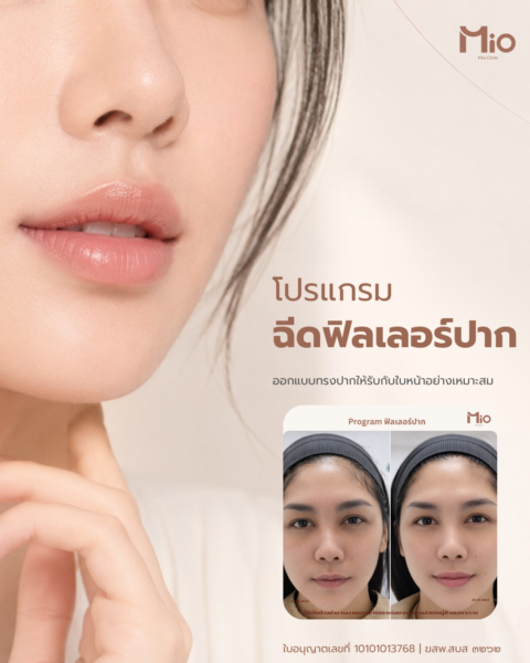 Mio-Website-Filler-Lips-โพสต์-Instagram-45-8