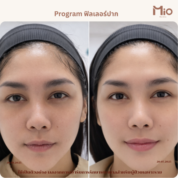 lip-filler-aesthetic-mio-clinic.jpg