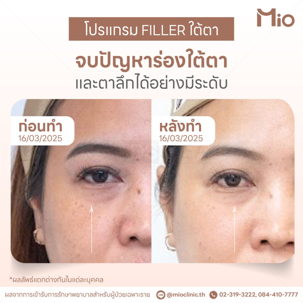 filler under eye hollow correction mio clinic.jpg
