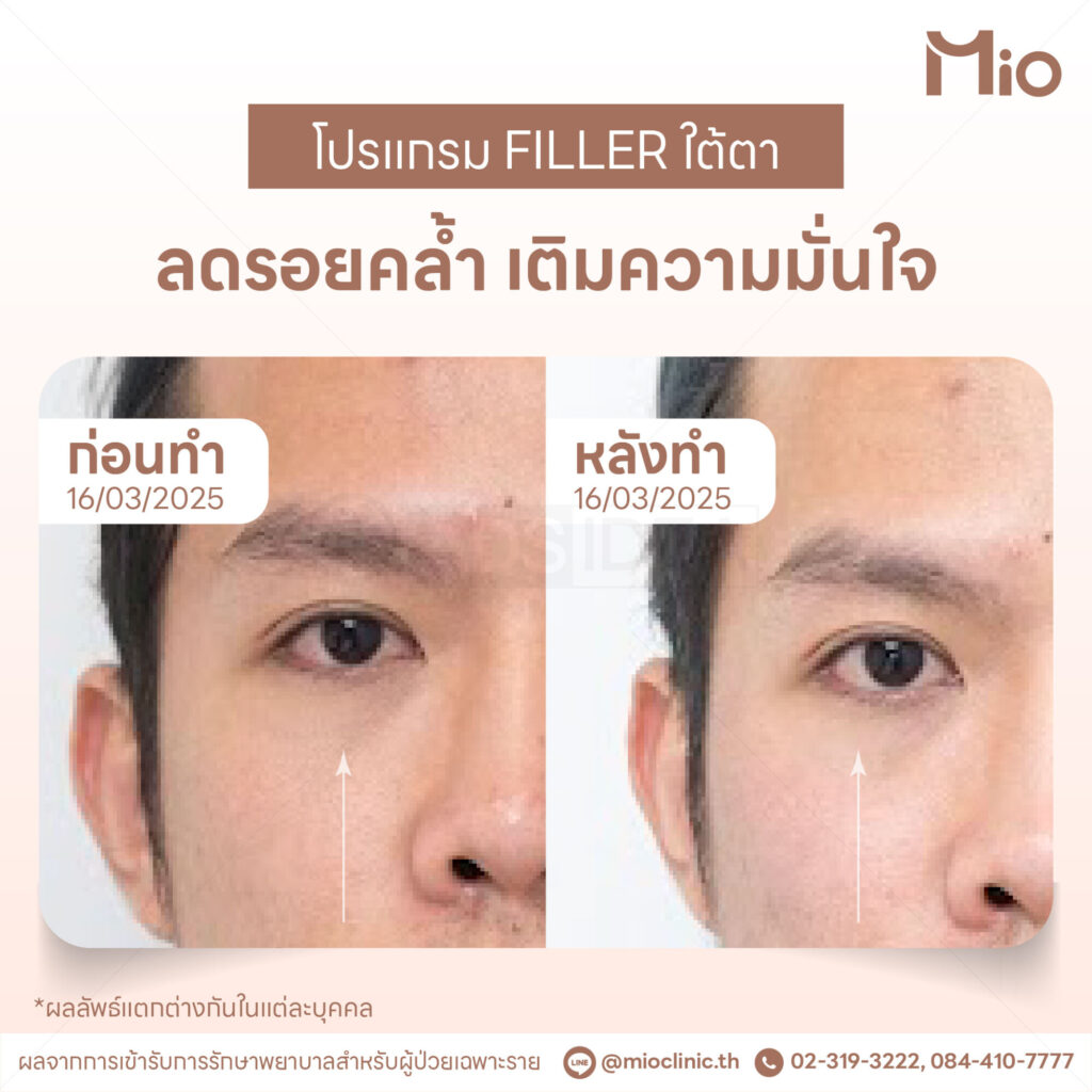 filler under eye review case1 mio clinic.jpg