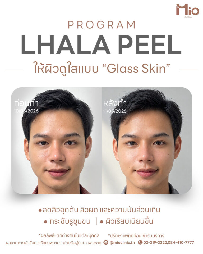 lhala peel review before after front mio clinic 1 day