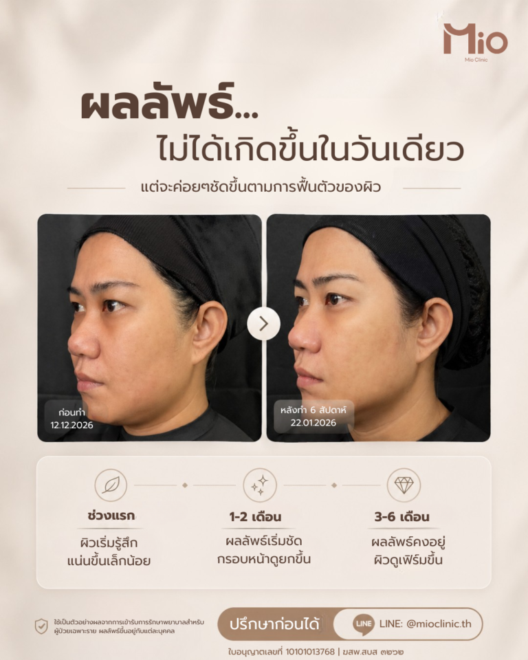 mio clinic doublo 2 review face lifting 6 weeks rama9