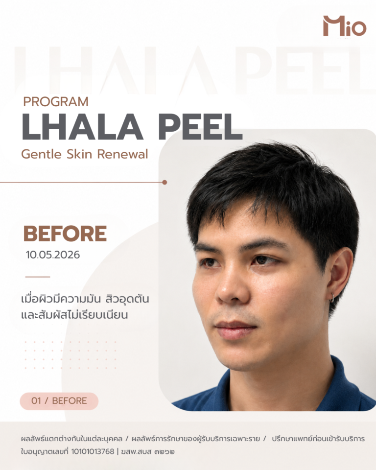 mio clinic lhala peel before oily congested skin review 10 05 2026