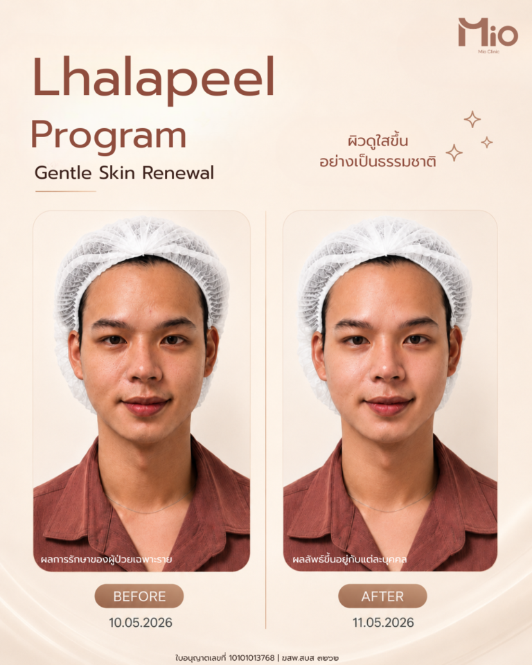 mio clinic lhalapeel review front view before after 2026