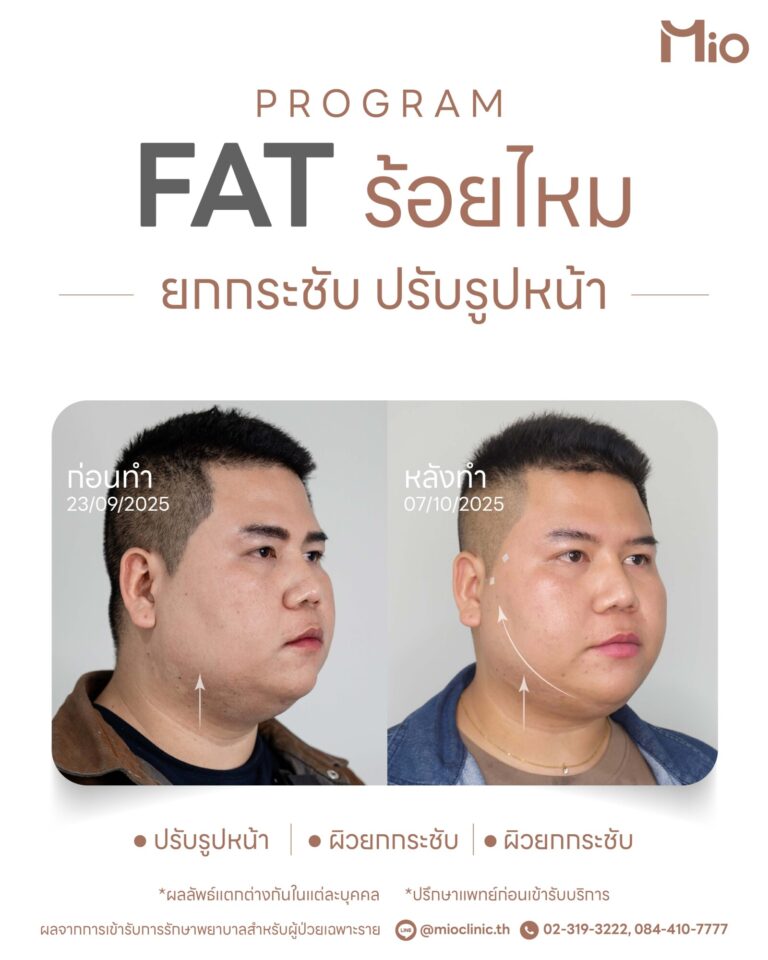 mio clinic male thread lift review 14 days
