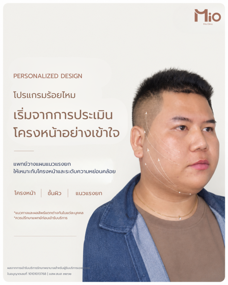 mio clinic personalized thread lift face assessment