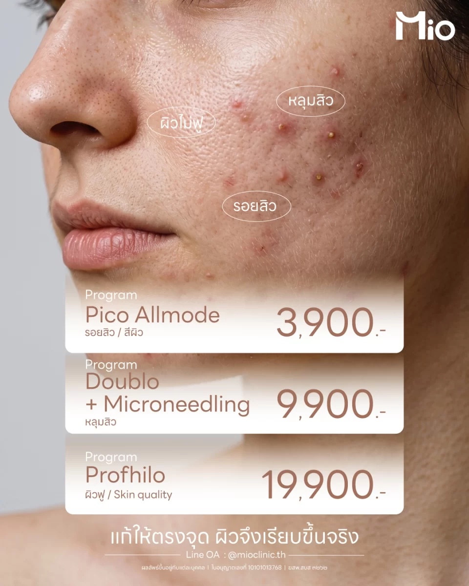 mio clinic promotion acne scar pore skin quality 1784278174