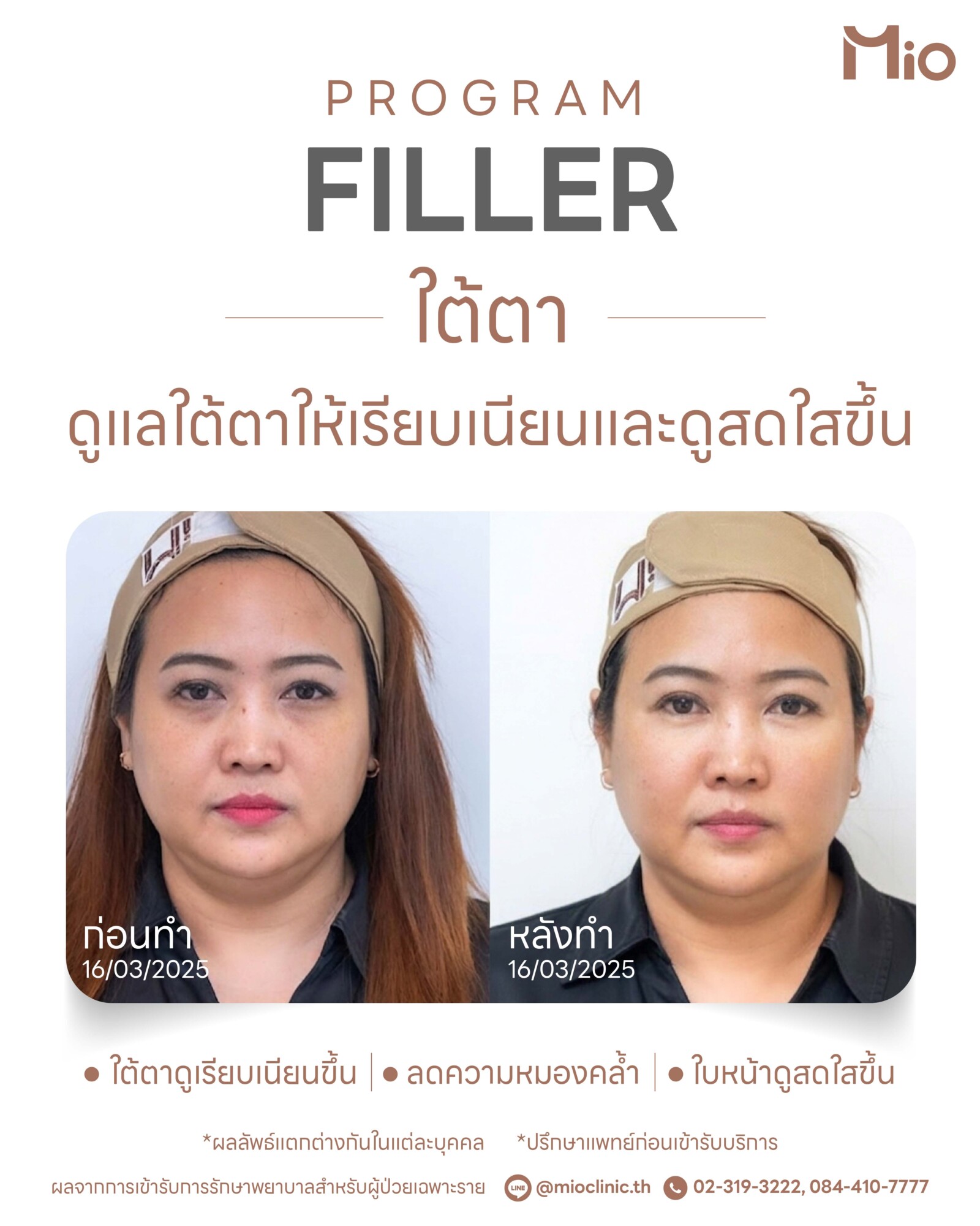 review-program-filler-under-eye-mio-clinic-before-after-01