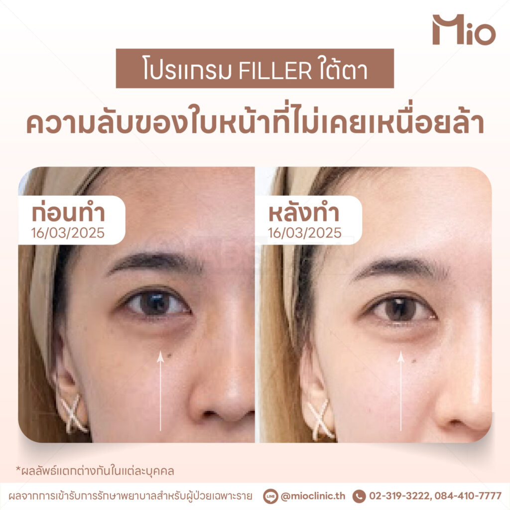 under eye filler review before after mio clinic