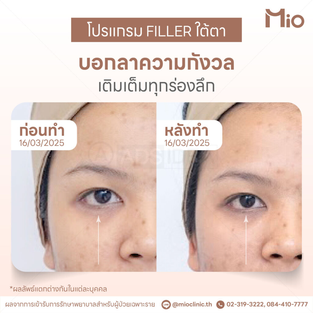 under eye filler review before after mio clinic case