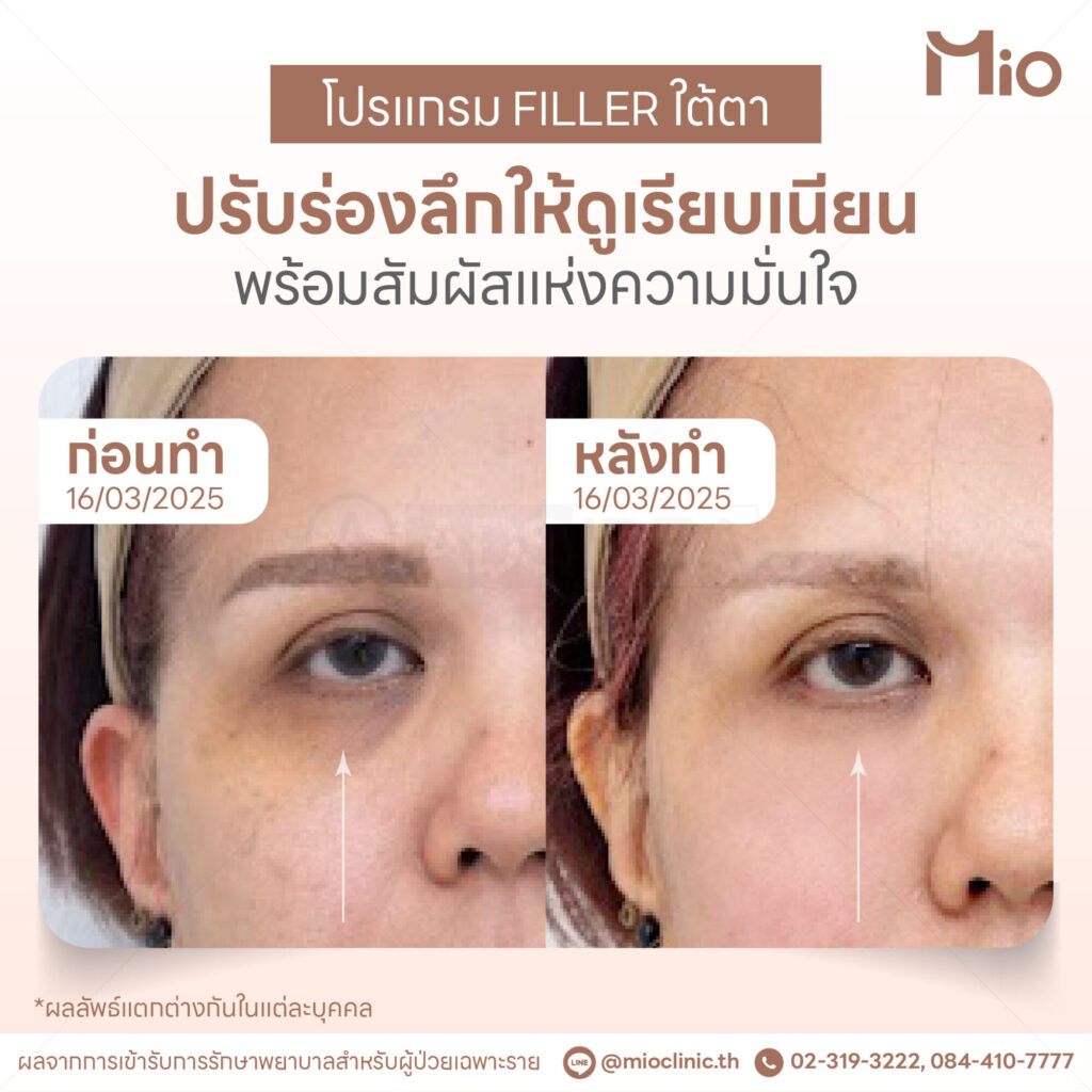 under eye filler review before after mio clinic.jpg