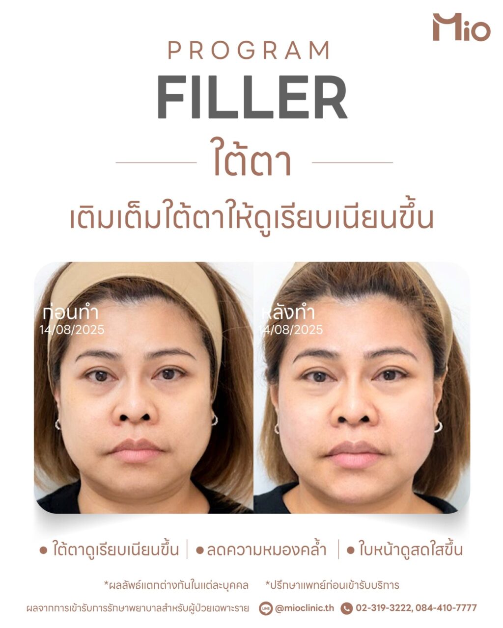 under eye filler review brighter face mio clinic 02 1