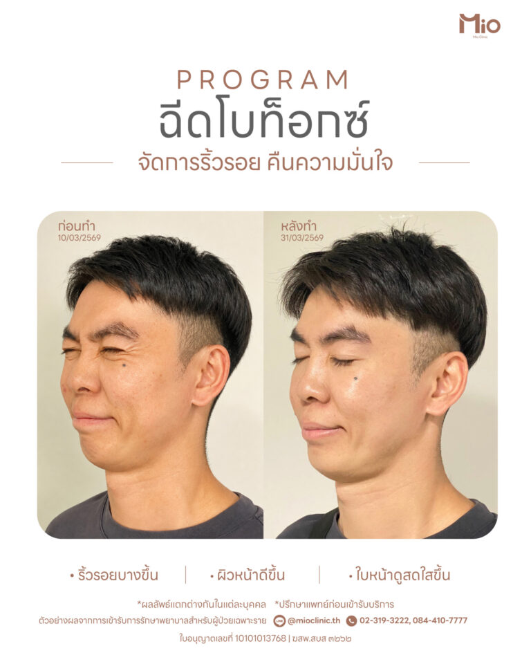 botox wrinkle review mio clinic rama9 21 days