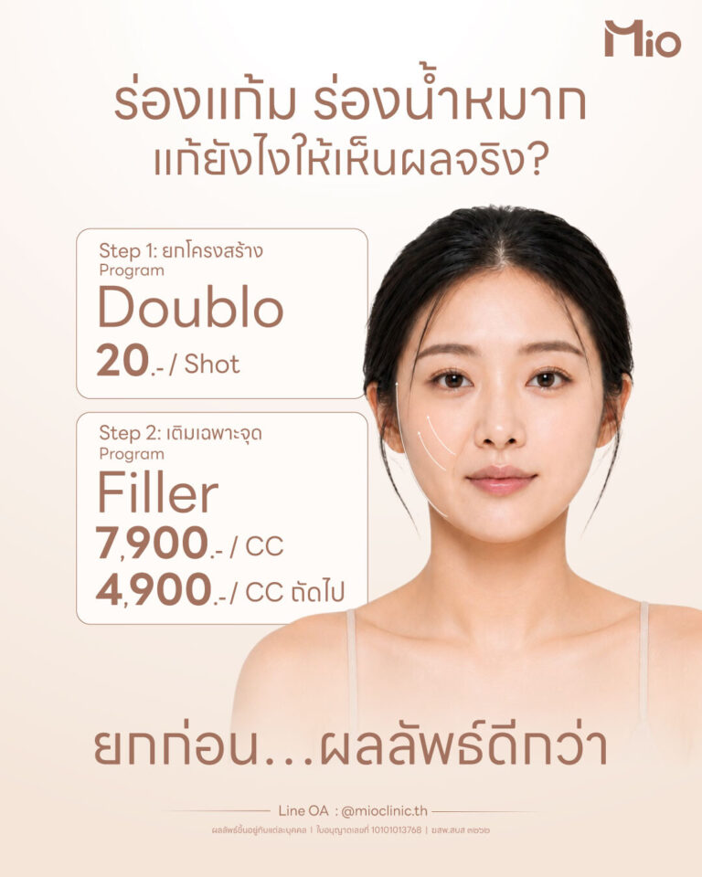 doublo filler nasolabial marionette lines promotion mio clinic
