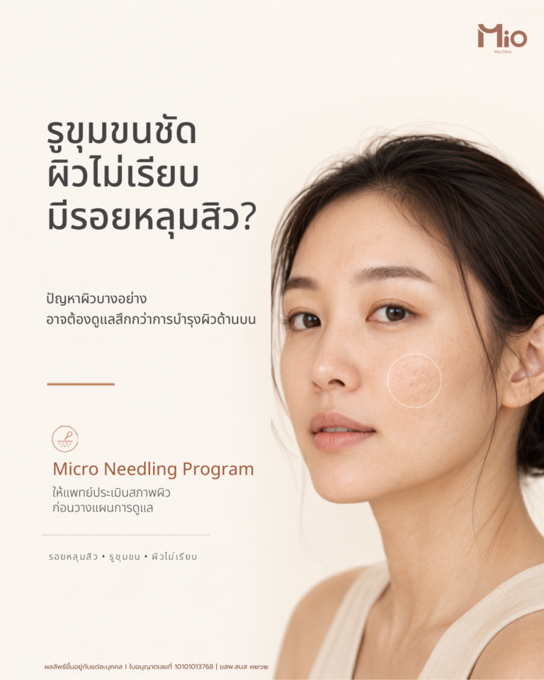 doublo microneedling acne scar pores skin texture mio clinic