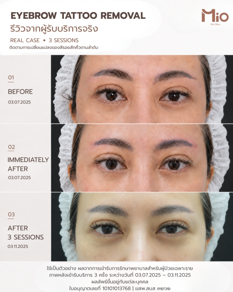 eyebrow tattoo removal review 3 sessions mio clinic 1