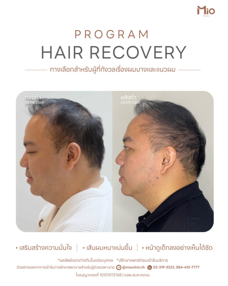 hair thinning hairline recovery review mio clinic rama9