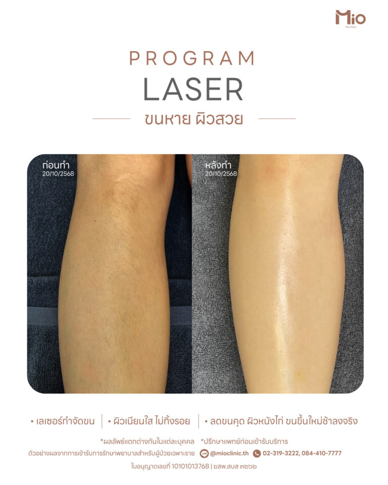 laser hair removal review before after mio clinic rama9