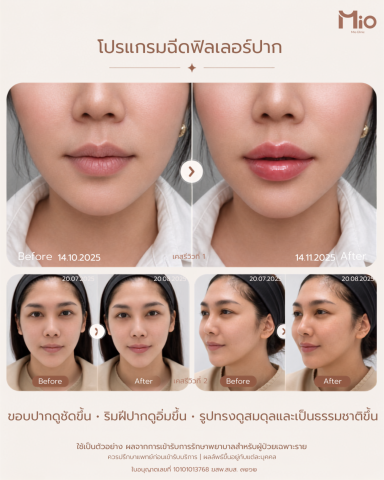 lip filler program review before after mio clinic instagram 2