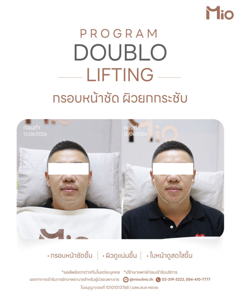 mio clinic doublo lifting review jawline before after 12062026