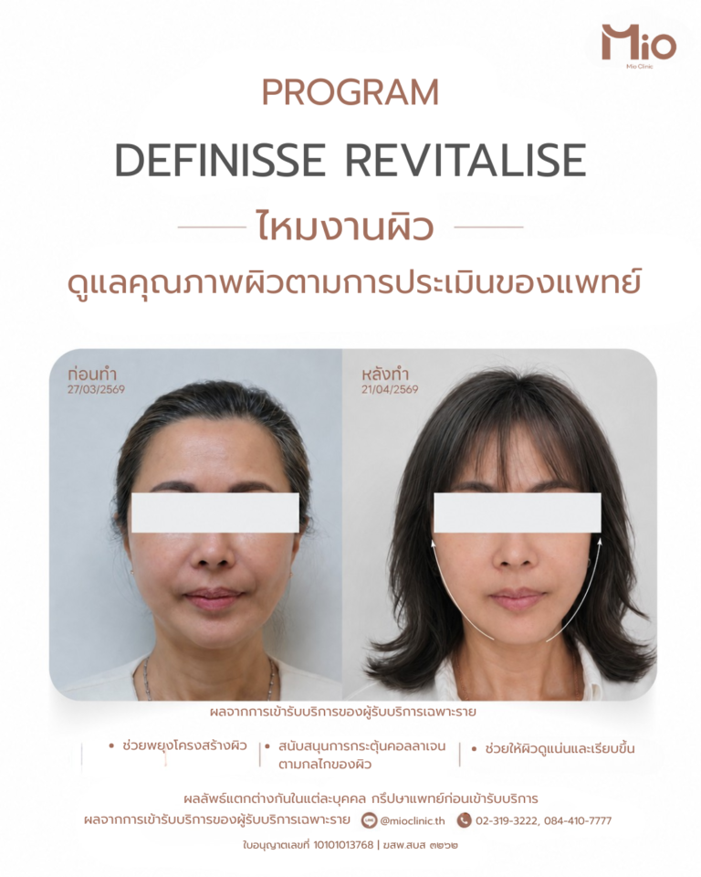 review definisse thread lift mio clinic before after 25 days
