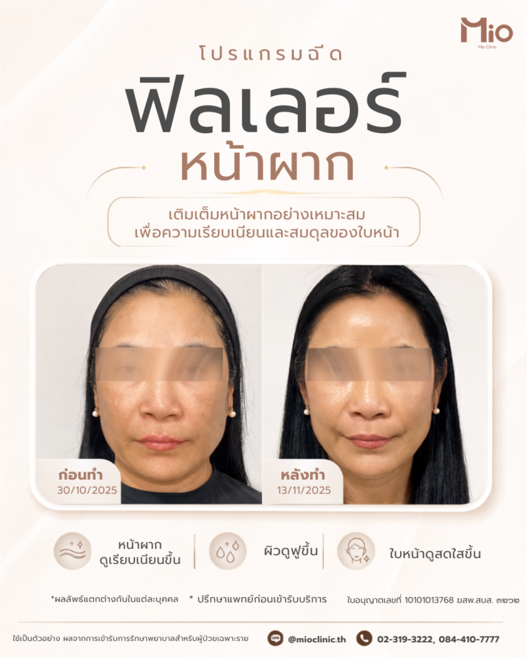 Filler Review หน้าผาก IG